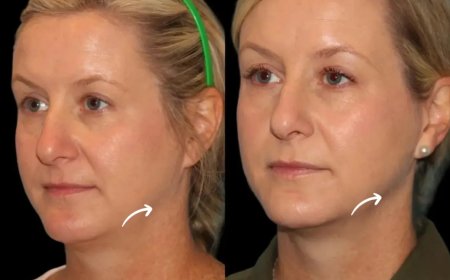 Feminizing Facial Features with Sculptra Fillers in Dubai: A Comprehensive Guide