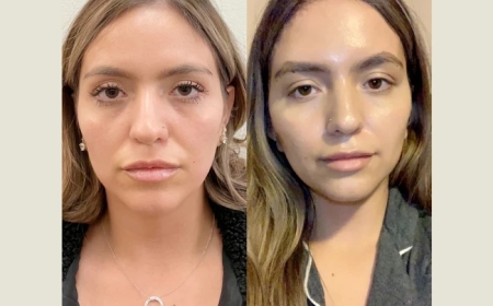 Thread Lift in Dubai: How Long Does the Procedure Take