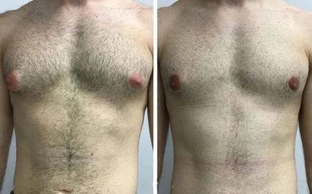 Gynecomastia in Dubai: How to Identify the Early Signs