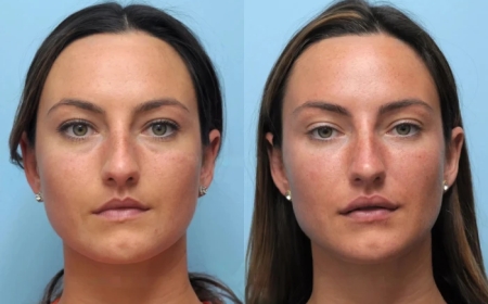 Non-Surgical Facelifts Made Easy with Thread Lift in Dubai