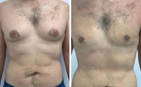 How to Prepare Yourself Mentally for Gynecomastia Surgery in Dubai