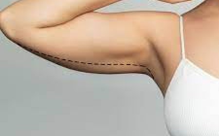 Arm Lift in Jeddah: Sculpt and Tighten Sagging Arms for a Toned Look