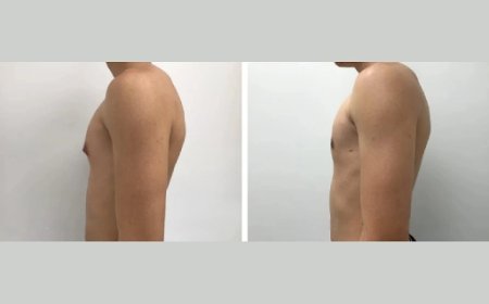 Avoiding Risks: Only Choose the Best Gynecomastia Surgeons in Dubai