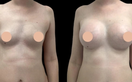 Why Breast Augmentation in Dubai Is on the Rise in 2025