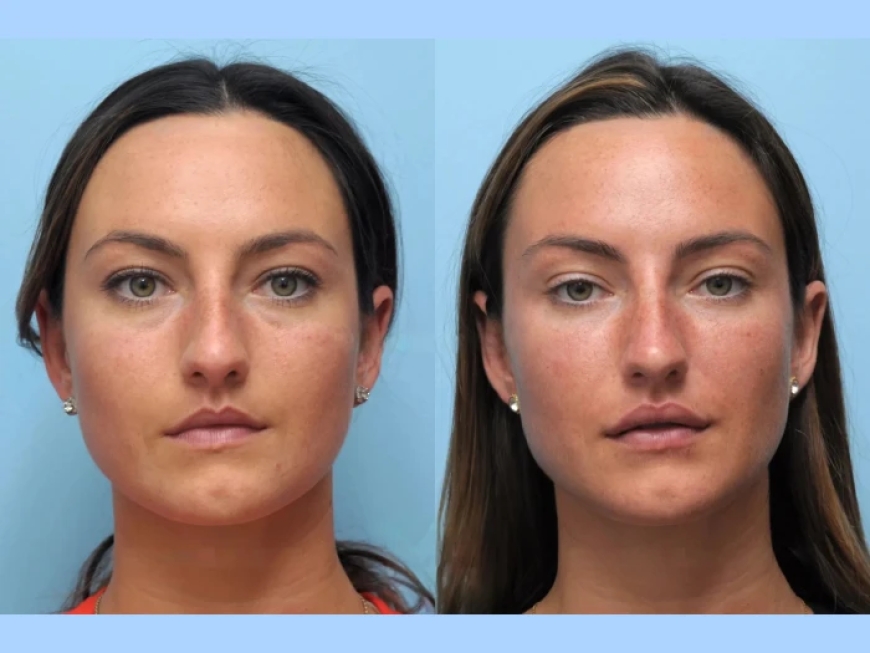 Non-Surgical Facelifts Made Easy with Thread Lift in Dubai