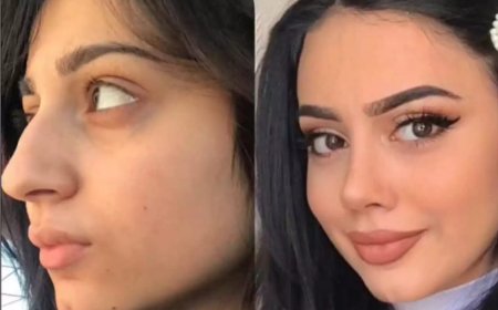 The Journey to Facial Balance with the Best Rhinoplasty Surgeon in Dubai