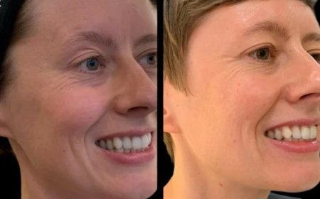 Boost Definition using Profhilo from the Best Plastic Surgeon in dubai