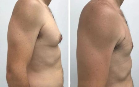 Understanding Your Gynecomastia Cost in Dubai: What You’re Paying For