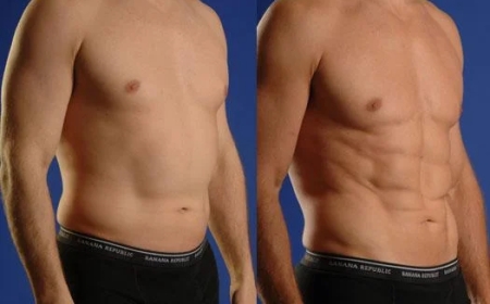 Cost and Procedure of Male Chest Fat Surgery in Islamabad Explained