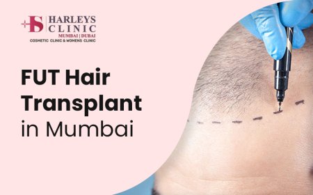 A Comprehensive Guide on FUT Hair Transplant