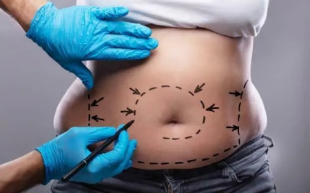 Why Liposuction Islamabad Is Gaining Popularity Among Cosmetic Treatments