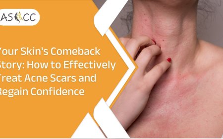 Your Skin's Comeback Story: How to Effectively Treat Acne Scars and Regain Confidence