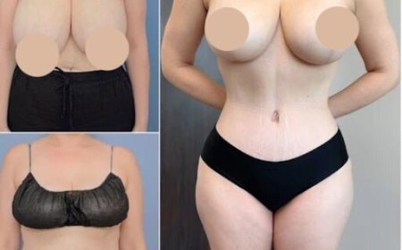 Best Tummy Tuck Surgeons in Dubai: The Key to Achieving Your Body Goals