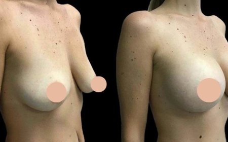 How the Best Doctors in Dubai Ensure Safe Breast Augmentation Procedures