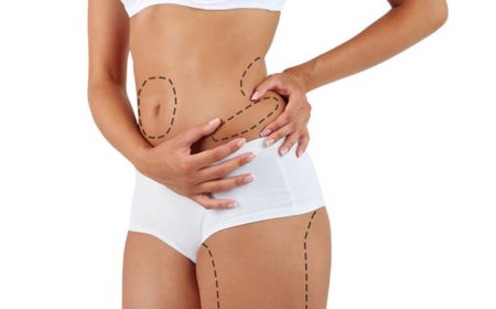 How Much Fat Can Be Removed with Liposuction?