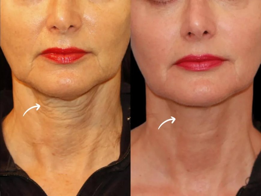 Addressing Volume Loss After Weight Loss with Sculptra Fillers Treatment in Dubai