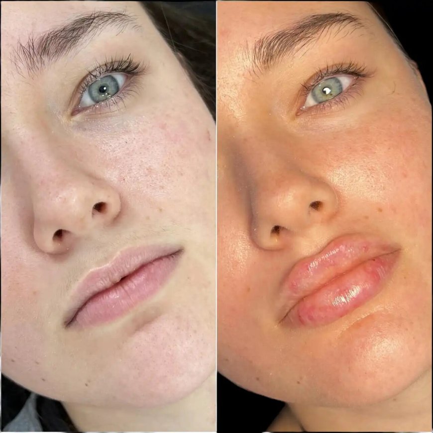 Fillers Treatment in Dubai: What Makes Treatment Effective