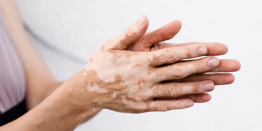 Effective Treatment Options for Vitiligo