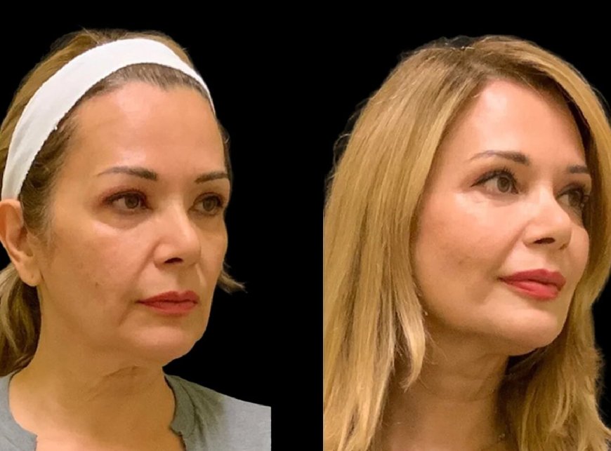 What’s the Ideal Age to Consider Cheek Fillers Treatments in Dubai?