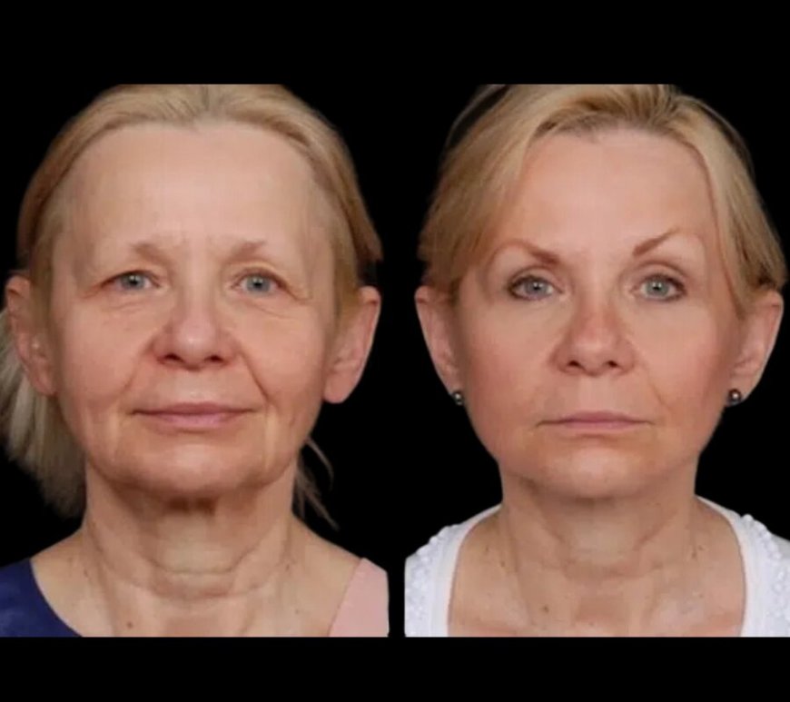 The Benefits of Under Eye Fillers Treatments in Dubai for Older Adults