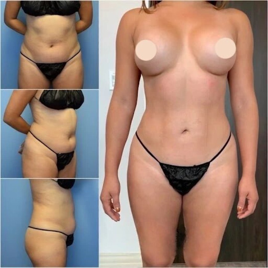 Best Body Contouring Surgeons in Dubai: Why Dubai is a Top Destination for Surgery