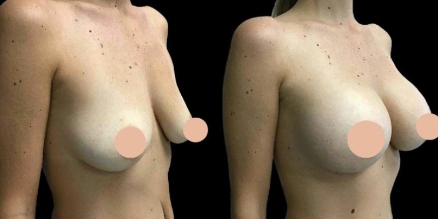 How the Best Doctors in Dubai Ensure Safe Breast Augmentation Procedures