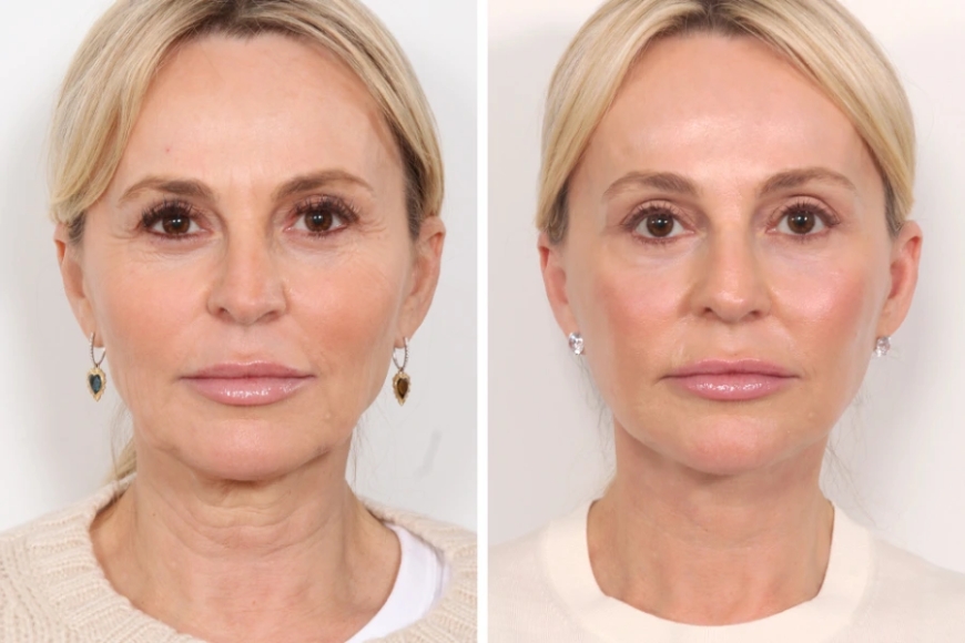 Thread Lift in Dubai: The Secret to a Youthful Look Without Surgery